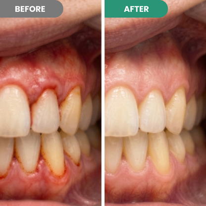 Teeth Repair Pen